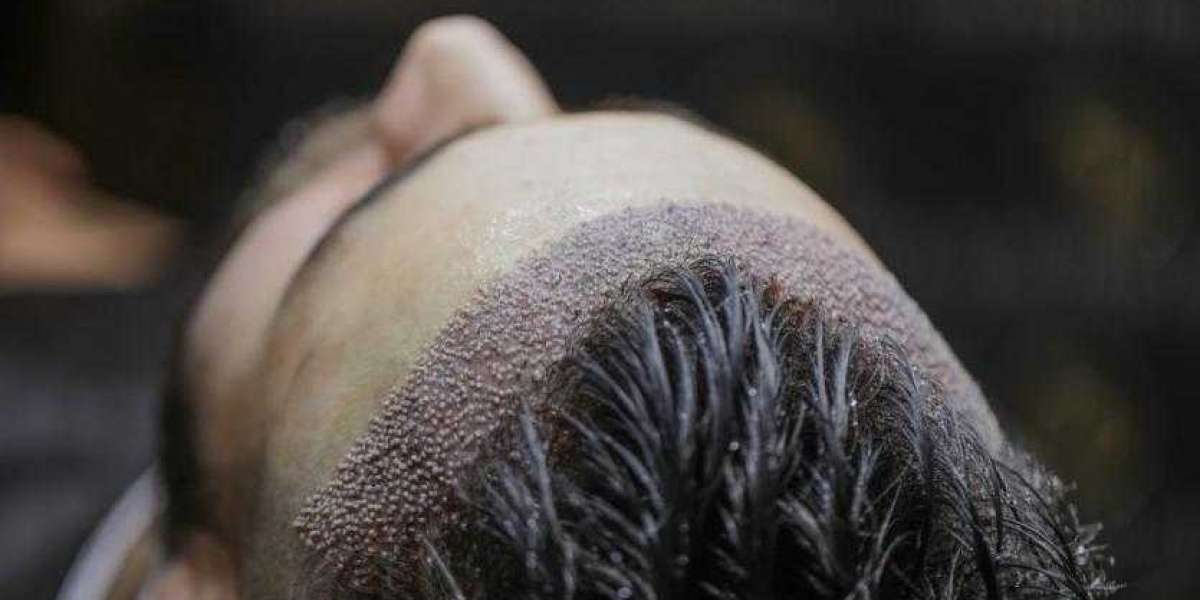 Existe alguna diferencia entre el tratamiento DHI y FUE? Trasplante de cabello DHI vs.FUE