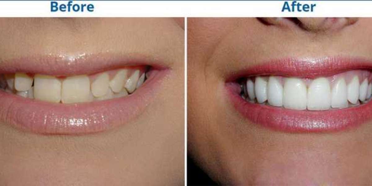 Some useful facts about porcelain teeth veneers