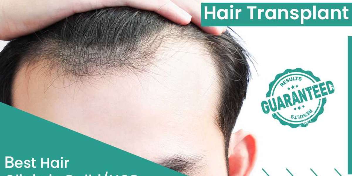 Best hair transplant treatment in delhi