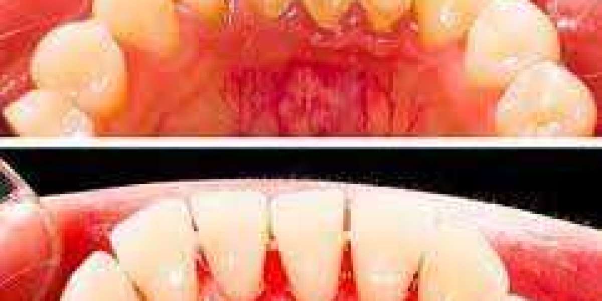 Why is periodontal and root scaling necessary?