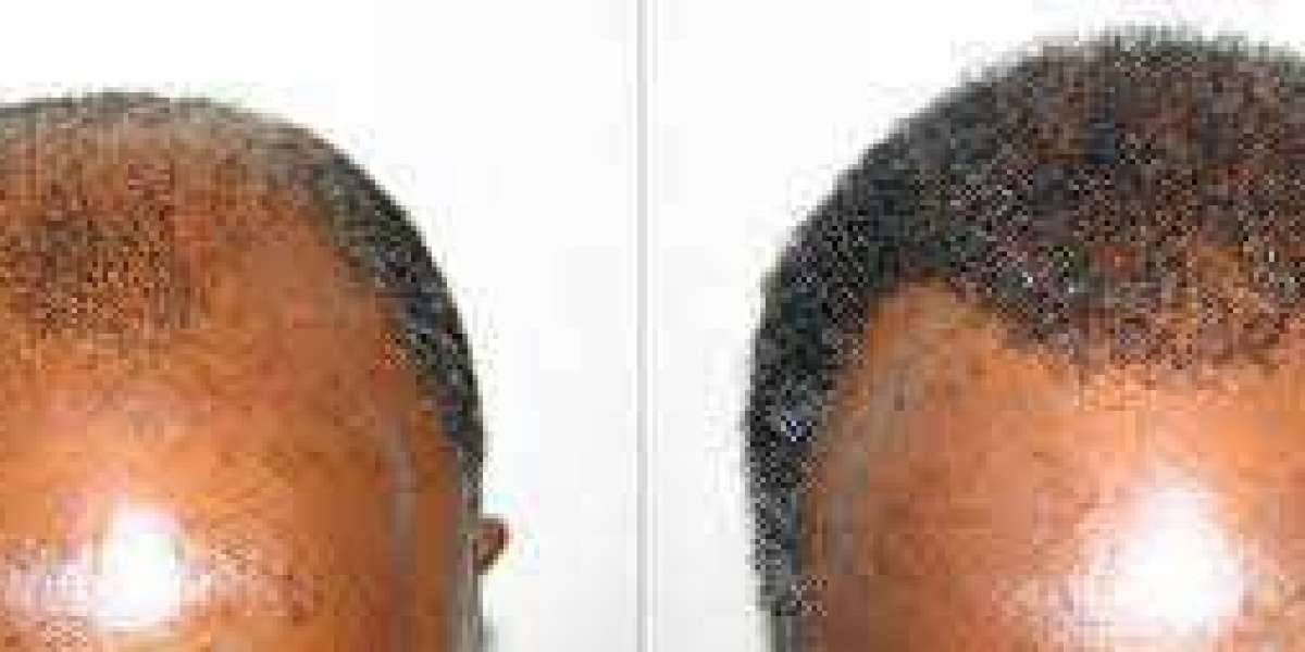 African American hair transplant cost