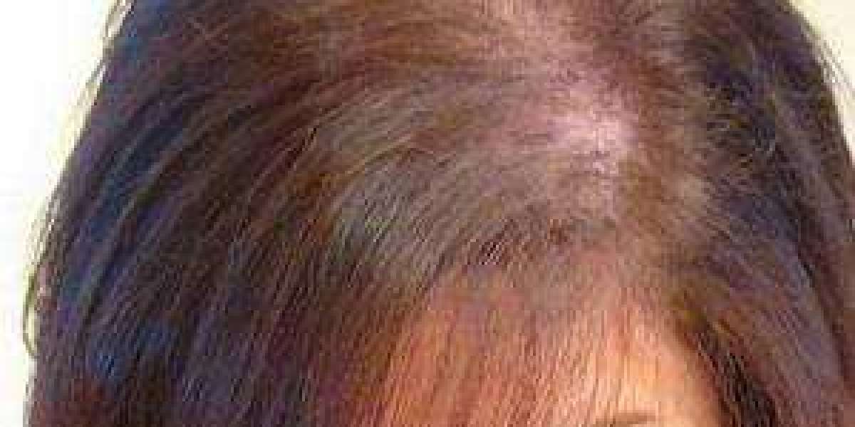 Perimenopause Hair Loss