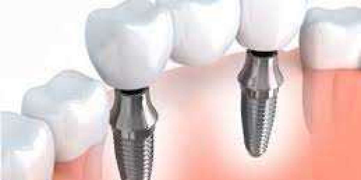 Dental implants cost in Delhi | Meraki Dental Studio