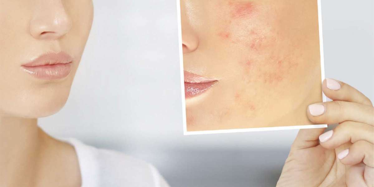 Transform Your Skin with Acne Scar Laser Treatment
