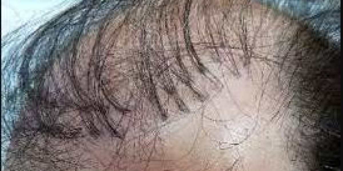 Hair Plug-Ins Near Me: A Comprehensive Guide to Hair Restoration