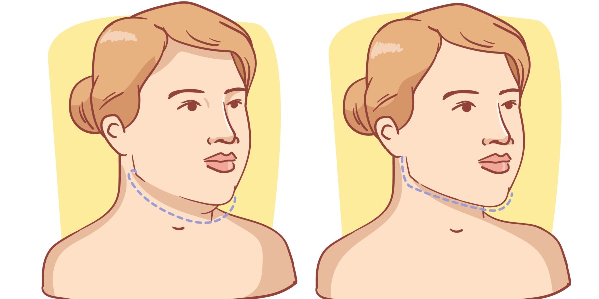 Uncovering the Best Treatment for Double Chin