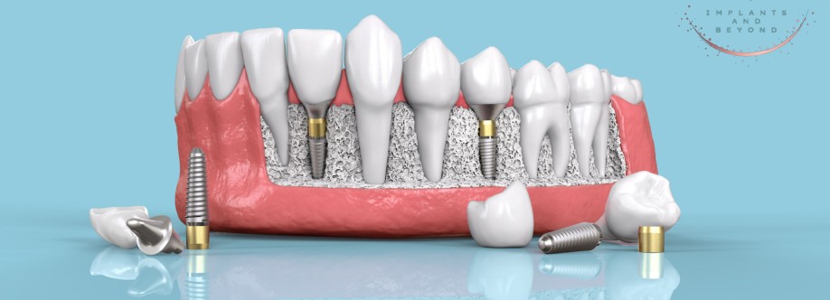 Dental Implant Surgery Cover Image