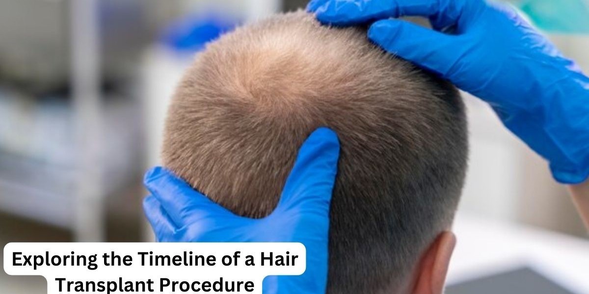 Exploring the Timeline of a Hair Transplant Procedure